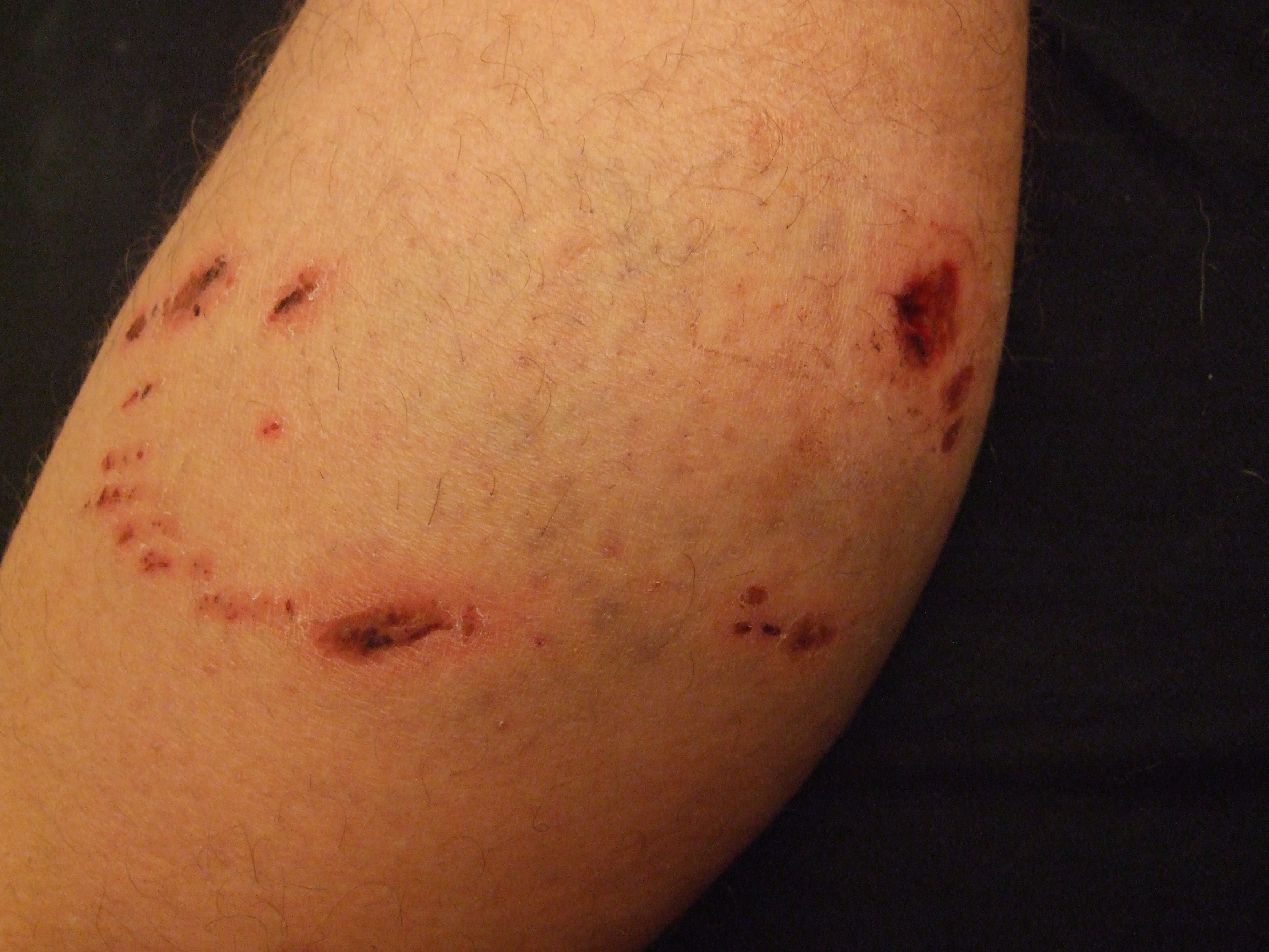 Dog bite wound (example photo showing bite marks and bruising)